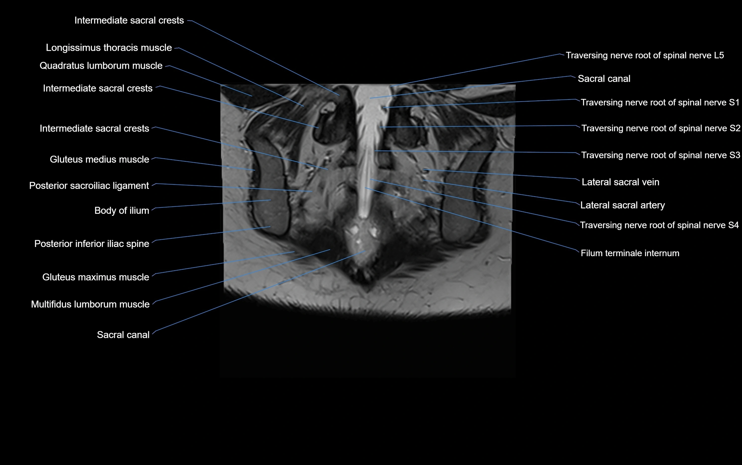 MRI sacroiliac joint coronal cross sectional anatomy  radiology  image-img-00001-00026.webp